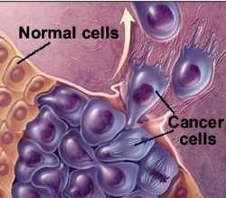 cancro inquinamento ambiente